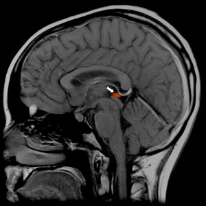 Umístění šišinky mozkové (epifýzy) uvnitř hlavy